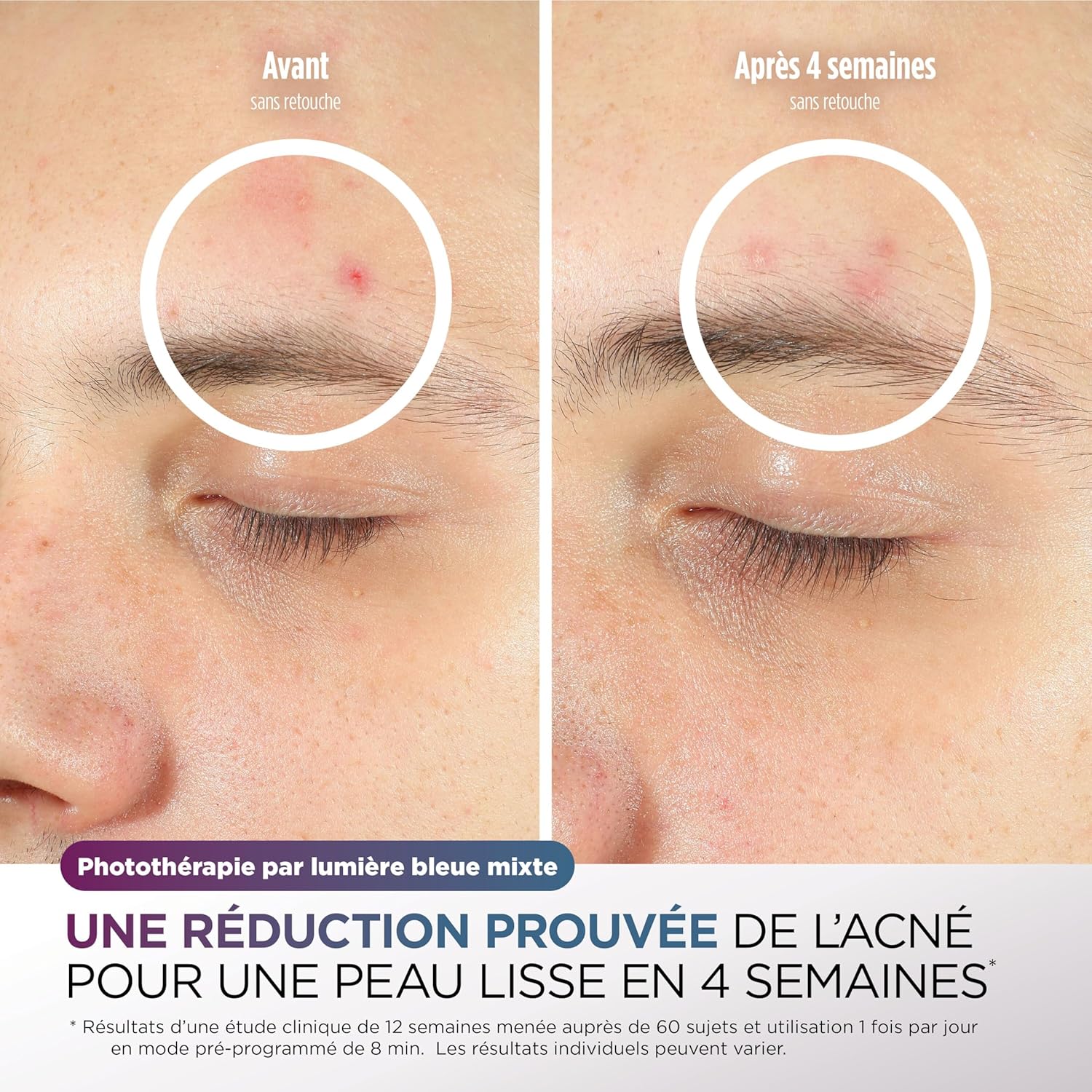 Shark Masque LED Visage Universel – Technologie Dermatologique à Domicile